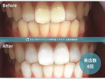 セルフホワイトニング専門店 シマエナ上新庄駅前店/4回でこの透明感
