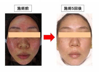 アンコンプレックス 名駅店(Uncomplex)の写真/天然シリカニードルの力で肌のターンオーバーを７日間に短縮！シミ・毛穴・ニキビなど様々なお悩みに適応♪