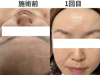 シアワセ(shiAwase)/【大阪本町】小顔矯正 B/A変化