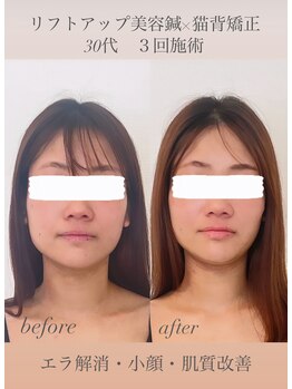 めい鍼灸院/リフトアップ美容鍼×猫背矯正