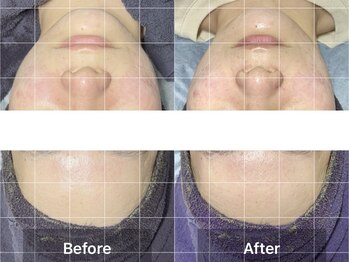 エモーショナル 姫路(Emotional)/ハーブピーリング×LDM【毛穴】