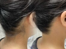 アールビューティー(R Beauty)/イベント前にうなじ脱毛