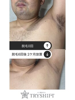 トライシフト 柏本店(TRY SHIFT)/メンズ_全身脱毛【柏】