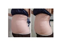 今　話題のレモンボトル!50代女性１回6ml導入