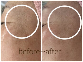 ペルボヌール 深井店/本気の肌質改善ハーブピーリング