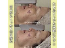 ハニエル(Haniel)/カーボキシー症例