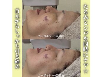 ハニエル(Haniel)/カーボキシー症例