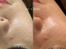 ビーグロウ(be Grow)/毛穴開き改善