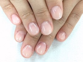 深爪矯正 施術後２