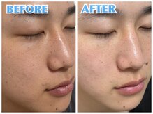 ラッシュ(RUSH)/美顔器施術（3ヶ月）