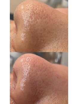 ディオーネ 春日井勝川店(Dione)/毛穴洗浄☆ビフォーアフター