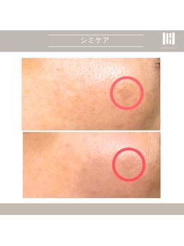 カリスボーテ 関本店/シミケア