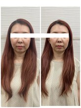 長寿鍼灸院 長寿整骨院/美容鍼50本の効果★小顔効果