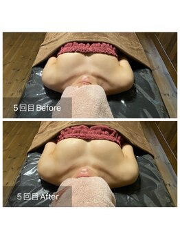 リノレア(LinoLea)/バストアップBefore after