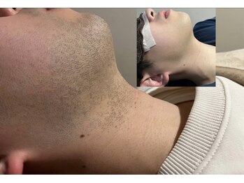 ブレイヴ(BRAVE)/男性も脱毛でコンプレックス解消