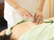 健康堂 綱島駅前店/背中の鍼灸施術