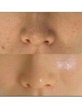 マリヴェリーテ(Mari verite)/毛穴×シミ改善