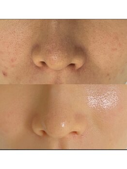 マリヴェリーテ(Mari verite)/毛穴×シミ改善