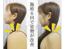 リバティ 世田谷代田整体院(Liberty)/短期集中改善後の姿勢