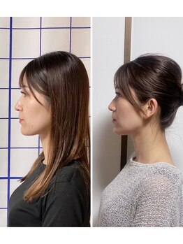 あらかき接骨院/【美容鍼】