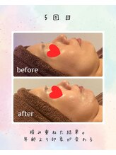 リリアン(lirien)/毛穴/毛穴ケア/毛穴洗浄/駒込