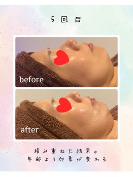 リリアン(lirien)/毛穴/毛穴ケア/毛穴洗浄/駒込