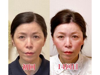 小顔22 ボルティ 赤坂支店(Bolty)/【中顔面の悩み】解消サロン