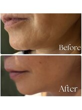 トータルサロン ヴィータ(VITA.)/レッドショット導入でスッキリ♪