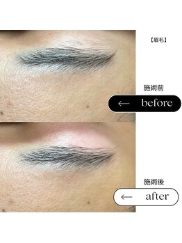 エスト(Est_.)/美容電気脱毛【眉毛】