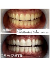 ホワイトニングサロン 京都烏丸店/ホワイトニング施術例
