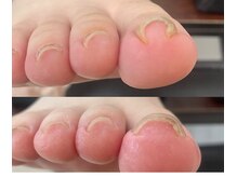 シーネイル(C Nail)/こんなに食い込んだ爪もスッキリ