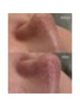 ミリ(MiLi)/毛穴エクストラクション