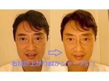 アポセオシス 目黒駅前(apotheosis)/その場で小顔（右だけ施術）　