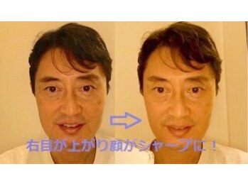 アポセオシス 目黒駅前(apotheosis)/その場で小顔（右だけ施術）　