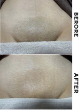 ゼロ 水戸店(ZERO)/VIO脱毛★before&after