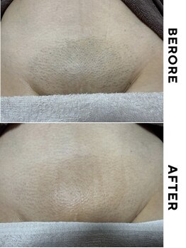 ゼロ 水戸店(ZERO)/VIO脱毛★before&after