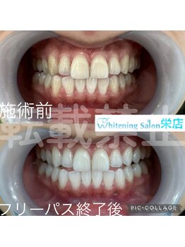 ホワイトニングサロン 名古屋 栄店/【ホワイトニング】