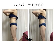 リヘッド(Re.head)/ハイパーナイフEXでくびれ爆誕