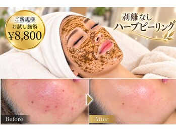 フルールドリス(FLEUR DE LIS)の写真/ハーブピーリングで透明感とツヤのある素肌へ★繰り返す肌悩み・毛穴ケアにも◎【ニキビケア／毛穴ケア】
