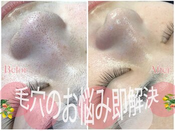 ディアメ(Diame)/毛穴のお悩み解決いたします!!