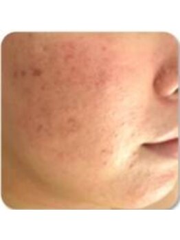 お顔そりローズマリー/ハーブピーリング