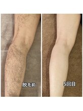 メンズガーデン 今池店/メンズ全身脱毛足脱毛