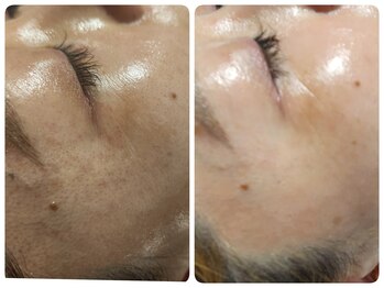 ロメリア(Roemeria)/お客様Before After