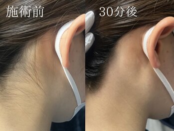 ミルダ(MIRUDA)/女性に大人気★うなじ脱毛