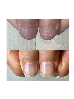 シー(sea)/深爪緩和