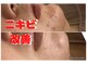 ジェンヌ(jenne.)の写真/毛穴とニキビ特化サロンによる徹底的な肌質改善で自分史上一番の肌に!初回6800円から♪