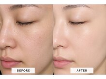 美巡の雰囲気（韓国式次世代ピーリングのプラピールで憧れの水光肌へ）