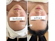 アリュール(Allule)/before after