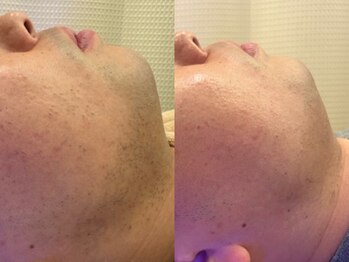 スリーズララ(Cerise LaLa)/ヒゲ脱毛のbefore→after