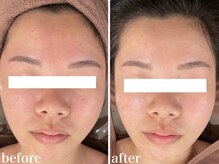 ホワイトアクア 北千住店(WHITE AQUA)/ハーブピーリング/肌質改善/毛穴